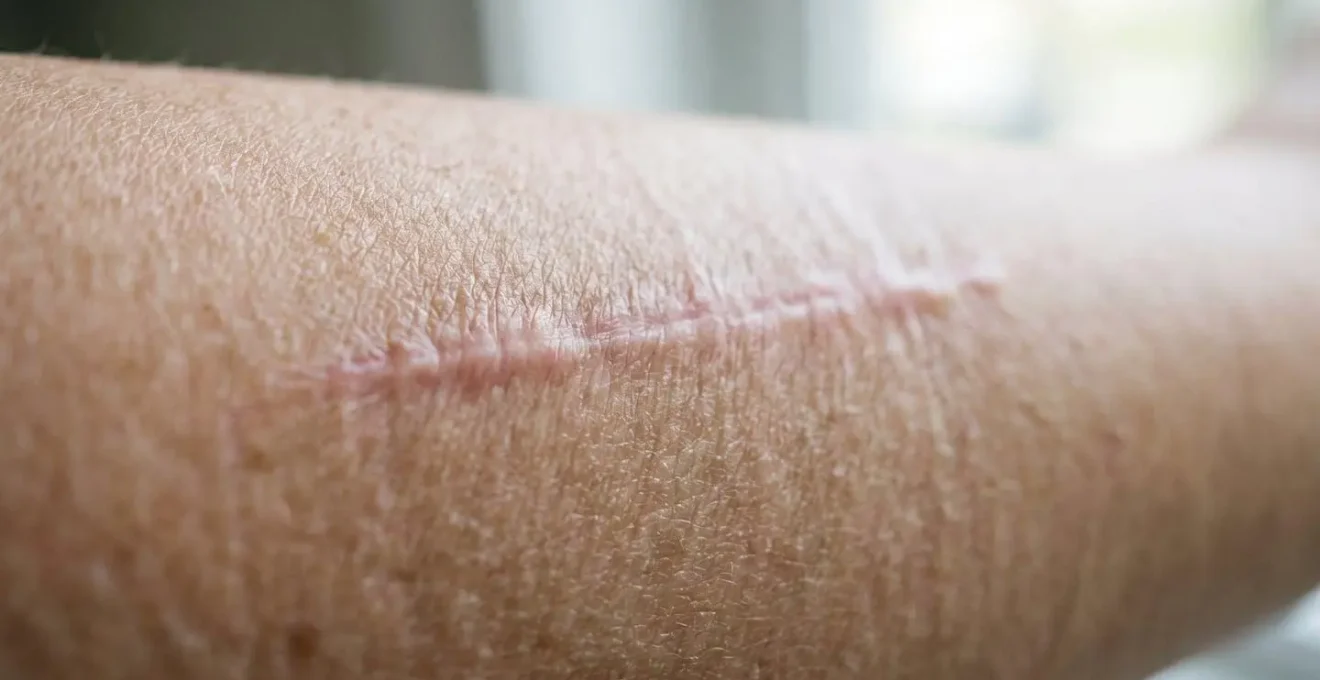 Gros plan sur une cicatrice cutanée sous lumière naturelle douce, texture de peau visible, symbolisant l'acceptation et la désensibilisation progressive